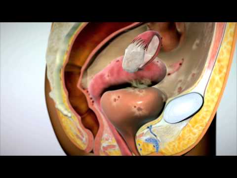endometrium - What is Endometriosis? Endometriosis is a painful, chronic disease that affects 1 in 10 women and girls. It occurs when tissue like that which lines the uter...