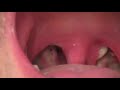 Tonsillectomy 8 Days After Surgery Tonsillectomy 8 Days After Surgery