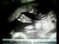 baby girl mclennan - 21 weeks