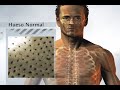Osteoporosis Osteoporosis