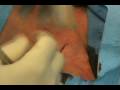 Ultrasound Guided Port Insertion