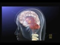 crps severe