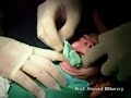 Feeding Obturatore for Ellias 4 month baby with Cleft Palate, Clinical Pediatric Dentistry