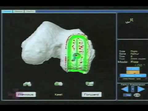 Robotic Arm Helps Surgeons and Patients