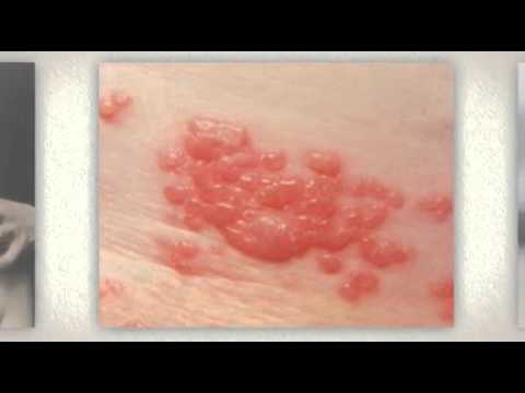how to keep eczema under control