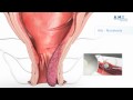 RAR Recto Anal Repair Hämorrhoiden- Behandlung: neue schnelle und schmerzarme Therapie