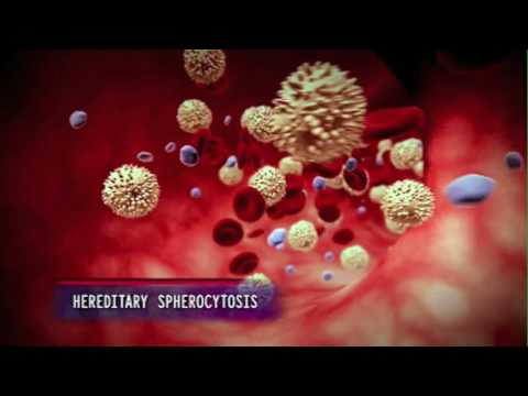 An Animation Explaining the Mechanisms Involved in Hereditary Spherocytosis
