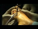 Cirugia del Pie - Foot Surgery - Hallus Valgus - Juanetes