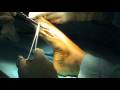 Cirugia del Pie - Foot Surgery - Hallus Valgus - Juanetes