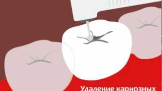 Восстановление коронки зуба пломбой