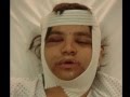 evolucummins   operacion maxilofacial