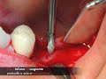 exacta-wp transmucoso
