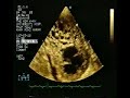 Isolated left ventricular non-compactionOne of major applications of echocardiography is to identify left ventricular systolic function and different forms of cardiomyopathies.A 37 years old man came with history of progressive shortness of breath for few months and features of congestive cardiac failure without any preceding history of any viral or bacterial infection.  EKG showed features of left atrial enlargement and left ventricular hypertrophy. His transthorasic echo showed apical and distal lateral wall hypertrophy with excessive trabeculatoins and intratrabecular recesses. The endocardial structure was two layered with increased noncomacted to compacted ratio. Also noted was severely reduced left ventricular systolic function with ejection fraction of 15%.Isolated ventricular noncompaction is a rare form of unclassified cardiomyopathy, previously known as 