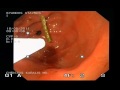 Foreign Body In The Stomach Foreign Body In The Stomach