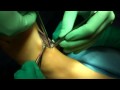 Dr. Patrick DeHeer, DPM - Lapidus Arthrodesis Part 1 for Hallux Abducto Valgus