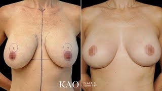 Breast Lift with no Inverted T Scars. Dr. Kao's Alexandra Breast Lift