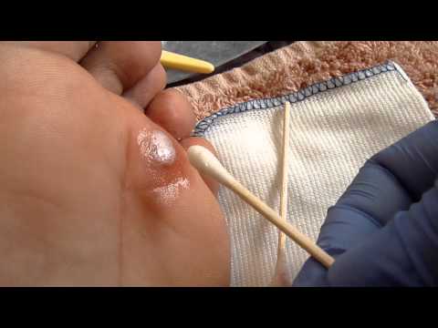 how to remove a splinter