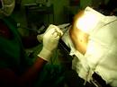 Anestesia