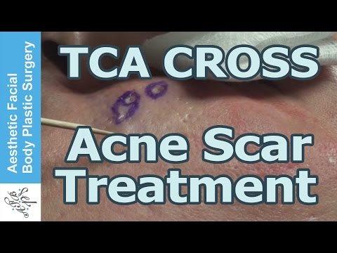 how to perform tca cross