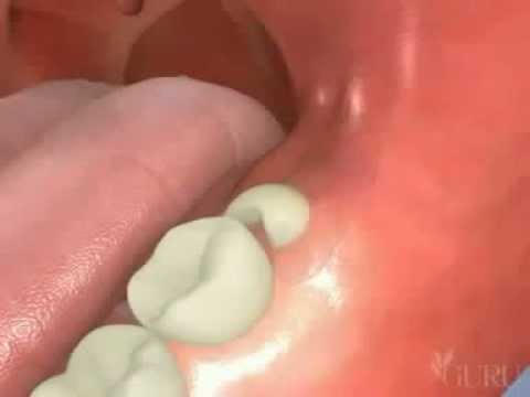 how to treat pericoronitis