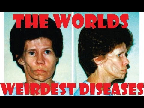 how to cure elephantiasis