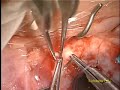 Baerveldt, Vitrectomy, Corneal Transplant Right eye