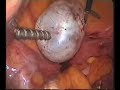 laparoscopic management of para ovarian cyst laparoscopic management of para ovarian cyst