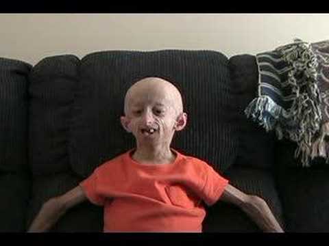 Hutchinson-Gilford Progeria syndrome is an extremely rare genetic condition 