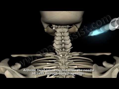 how to relieve cervical pain