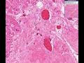 Histopathology Heart --Myocardial infarct, remote
