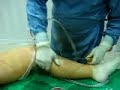 Liposuction - WAL of thigh and leg Liposuction - WAL of thigh and leg