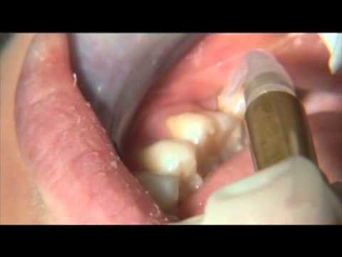 how to get rid of s'sinus infection