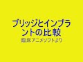 ブリッジとインプラント