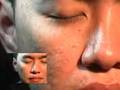 ulat resdung keluar dari muka...(video)