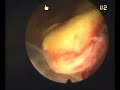 Hysteroscopic aspect of trophoblastic retention