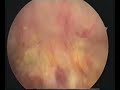 Hysteroscopic aspect of trophoblastic retention