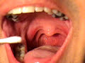 s removal tonsillolith removed