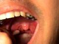 tonsil stone removal tonsillolith removed