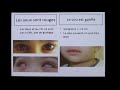 Click to View : Reconnaissance/diagnostic et suivi Maladie de Kawasaki - Pr.koné-paut - CHU Kremlin Bicêtre nov. 2018