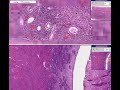 Histopathology Endometrium --Senile atrophy Histopathology Endometrium --Senile atrophy