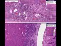 Histopathology Endometrium --Senile atrophy
