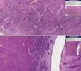 Histopathology Endometrium --Senile atrophy