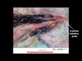 This is an overview of the Taquari DFS avulsion as seen in a time series of Landsat images. There are four other videos in this series. For a full description of this work, see the following article: Buehler, Weissmann, Scuderi, and Hartley, Spatial and temporal evolution of an avulsion on the Taquari River distributive fluvial system from satellite image analysis: Journal of Sedimentary Research, v. 81, p. 630-640, DOI: 10.2110/jsr.2011.040.