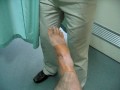 Inversion taping for Tibial Fasciitis, MTSS, Shin Spints