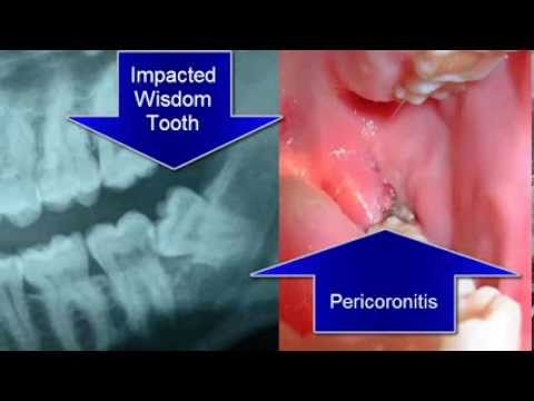 how to relieve impacted wisdom tooth pain