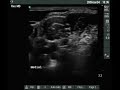 Ultrasound views of brachial plexus (interscalene)