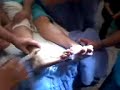 minima invasiva hallux valgus 7