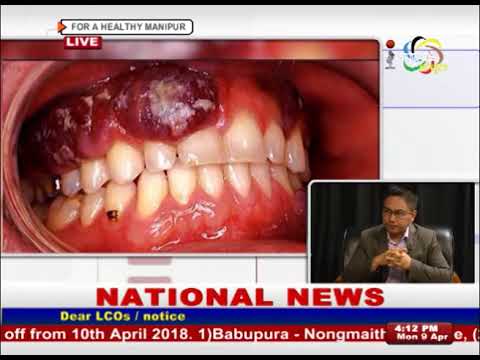 Oral Cancer On Impact Health Link 09 April 2018