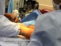 transumbilical breast augmentation through the navel