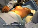 transumbilical breast augmentation through the navel